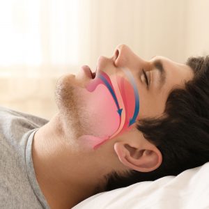 Valutazione e riabilitazione dei pazienti con disturbi respiratori del sonno in etÃ  pediatrica e adulta
